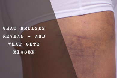 A visual showing the colour progression of a bruise over time, from red and purple to green, yellow, and brown, illustrating stages of healing.