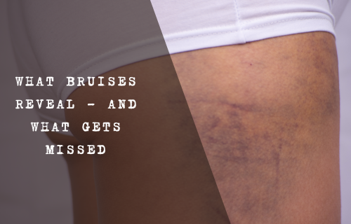 A visual showing the colour progression of a bruise over time, from red and purple to green, yellow, and brown, illustrating stages of healing.