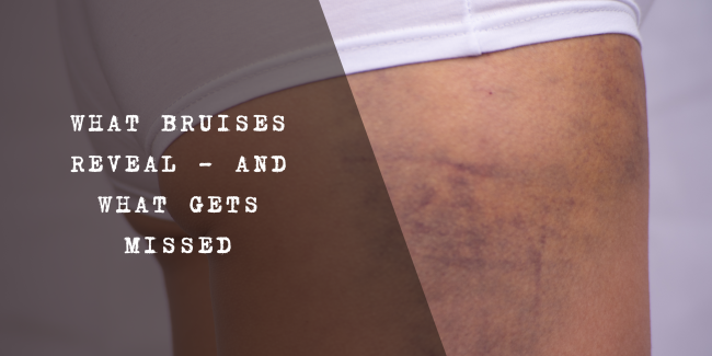 A visual showing the colour progression of a bruise over time, from red and purple to green, yellow, and brown, illustrating stages of healing.