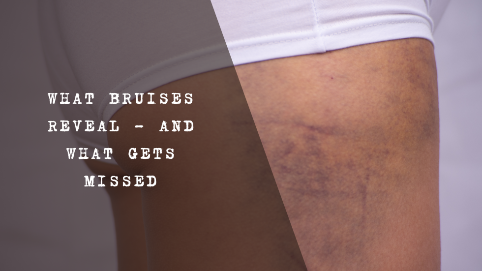 A visual showing the colour progression of a bruise over time, from red and purple to green, yellow, and brown, illustrating stages of healing.